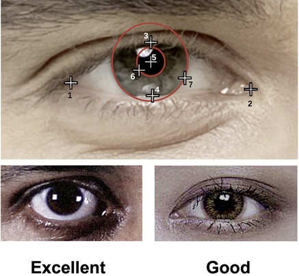 Development and Assessment of an Artificial Intelligence-Based Tool for Ptosis Measurement in Adult Myasthenia Gravis Patients Using Selfie Video Clips Recorded on Smartphones